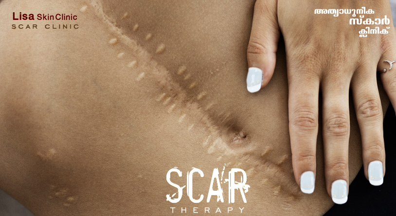 scar therapy for acne scar using non surgical energy based protocols for Melasma, Acne Scars, Skin Aging, Scars and Keloids, Warts at signature aesthetic centre in calicut by board certified dermatologist certified by A4M - American Academy of Anti-Aging Medicine